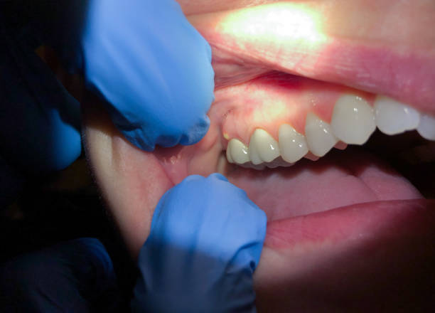Best Emergency Care for Gum Disease in Myerstown, PA